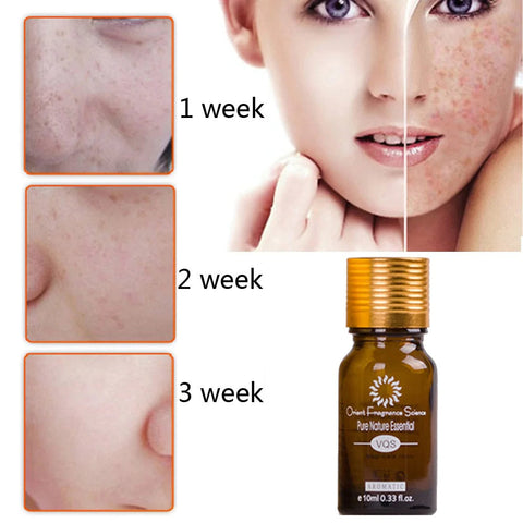 Natural Acne Removal Scar Oil